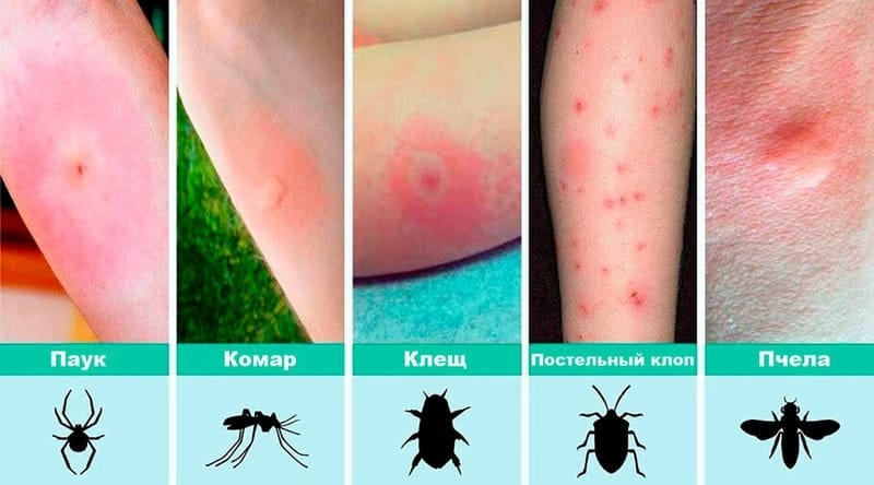 От красных пятен до язв на коже: как днепрянам распознать самые распространенные укусы насекомых. Новости Днепра