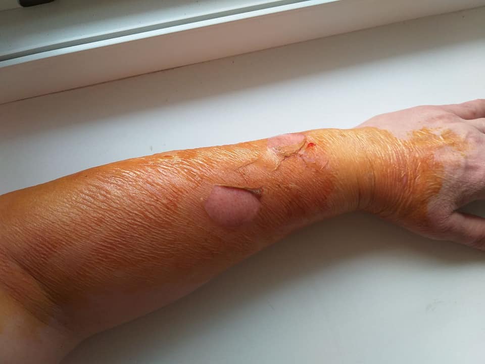 В Днепре в 107 маршрутке взорвался бак с тосолом: пассажирке полностью обожгло руку (Фото)