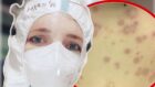 Кожные проявления коронавируса у детей - новости Днепра