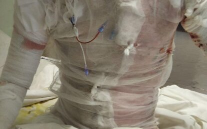 Новини Дніпра: Лікарі Дніпра врятували бійця з опіками