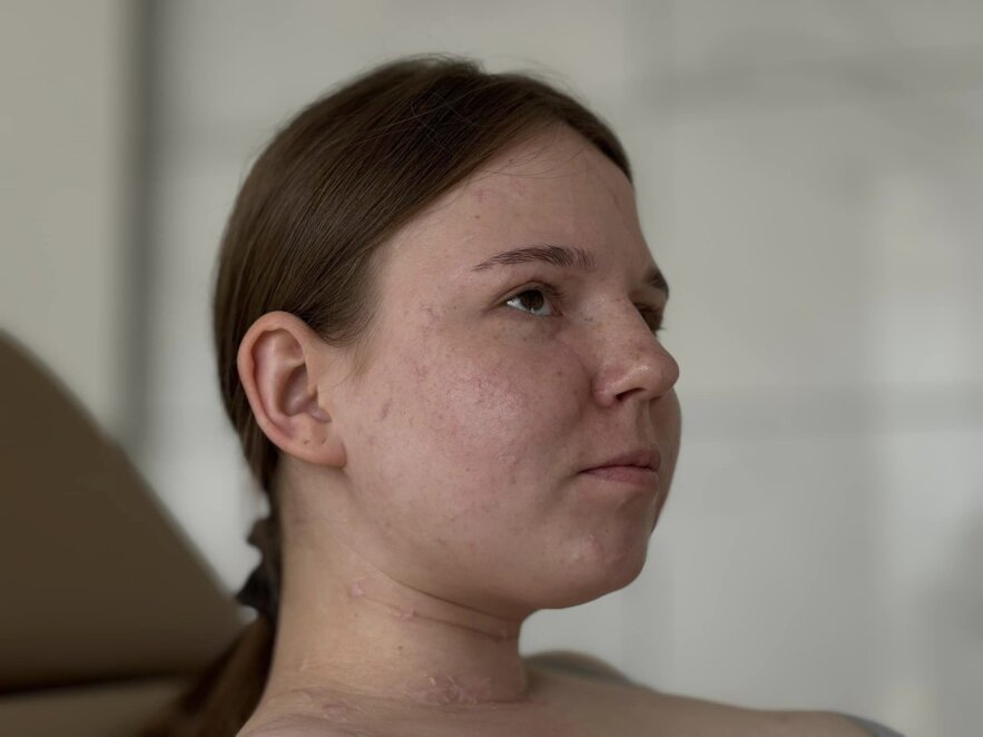 Осколки стекла изуродовали лицо: история девушки, которая пережила ракетный удар рф год назад в Днепре