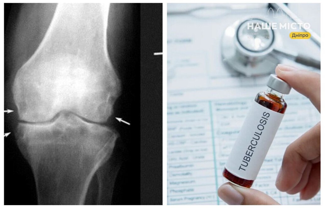 туберкульоз кісток