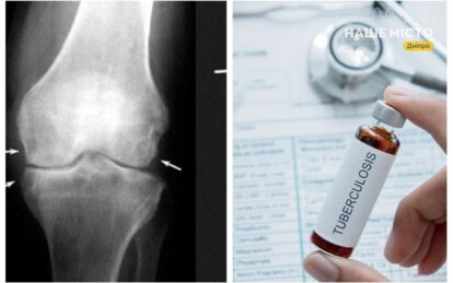 туберкульоз кісток