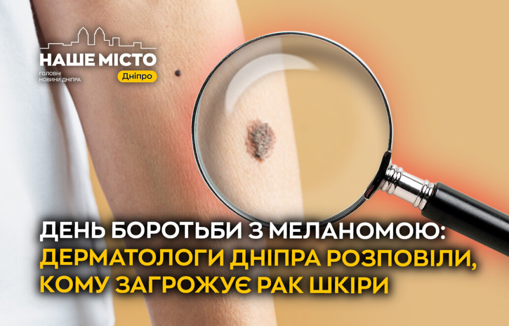 День меланоми 24 квітня 2026: дерматологи Дніпра про ризик.